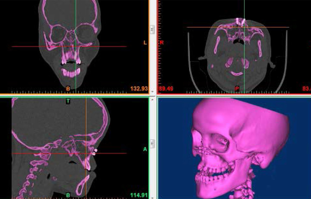 Improving CRPM has changed the face of constructive surgery