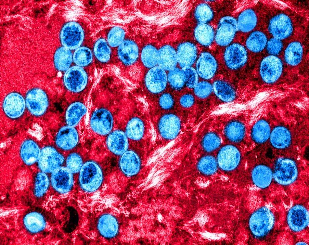 Government says mpox is under control but cites Covid-19 pandemic in urging caution